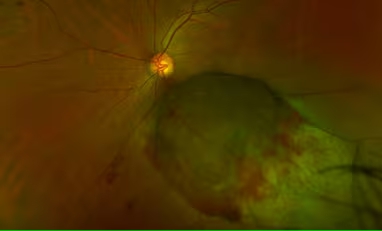 बिना चीर-फाड़ आंख के कैंसर का एम्स में हो रहा इलाज, अब तक 10 हजार मरीजों को मिला लाभ
